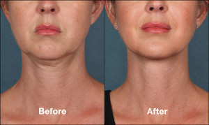 Milwaukee Kybella Patient Before and After