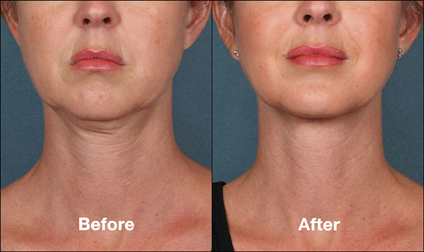 Milwaukee Kybella Patient Before and After